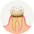 歯と歯茎の間に歯垢がたまります